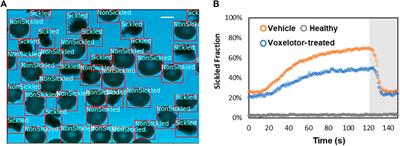 A framework of computer vision-enhanced microfluidic approach for automated assessment of the transient sickling kinetics in sickle red blood cells